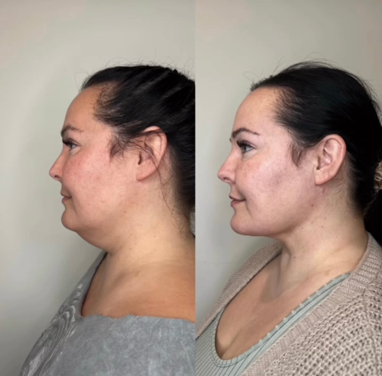 Kybella injections